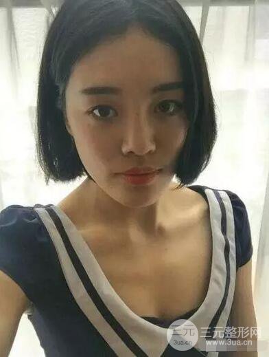 成都玉之光自體脂肪面部填充劉中國(guó)真人案例反饋|內(nèi)附對(duì)比前后照