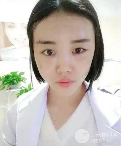 成都玉之光自體脂肪面部填充劉中國(guó)真人案例反饋|內(nèi)附對(duì)比前后照