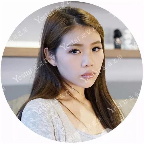 北京藝星仇侃敏耳軟骨隆鼻恢復(fù)過(guò)程|內(nèi)附前后對(duì)比圖