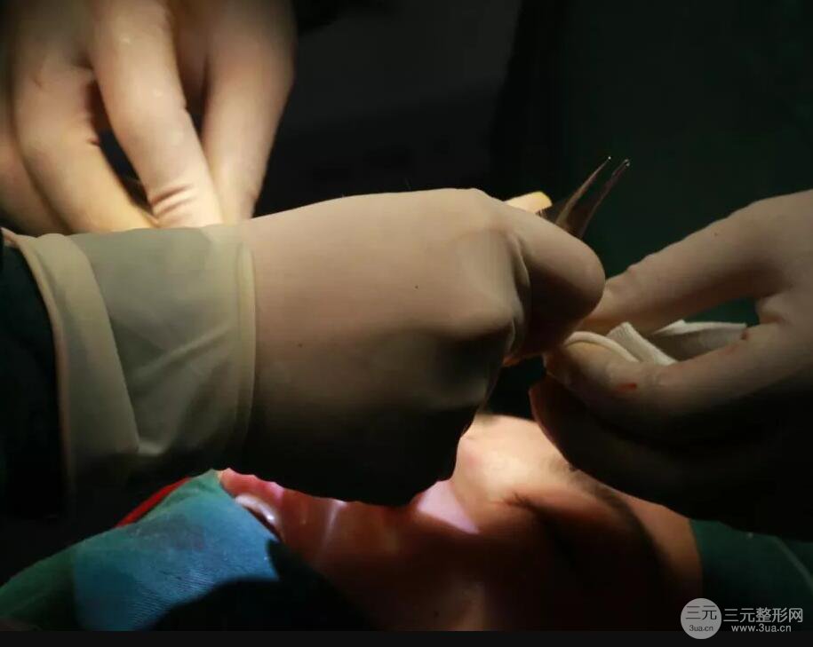 北京藝星仇侃敏耳軟骨隆鼻恢復(fù)過(guò)程|內(nèi)附前后對(duì)比圖