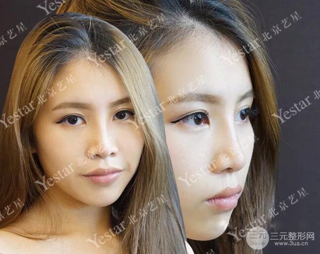 北京藝星仇侃敏耳軟骨隆鼻恢復(fù)過(guò)程|內(nèi)附前后對(duì)比圖