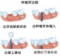 深圳種植牙多少錢一顆?價(jià)格是多少?