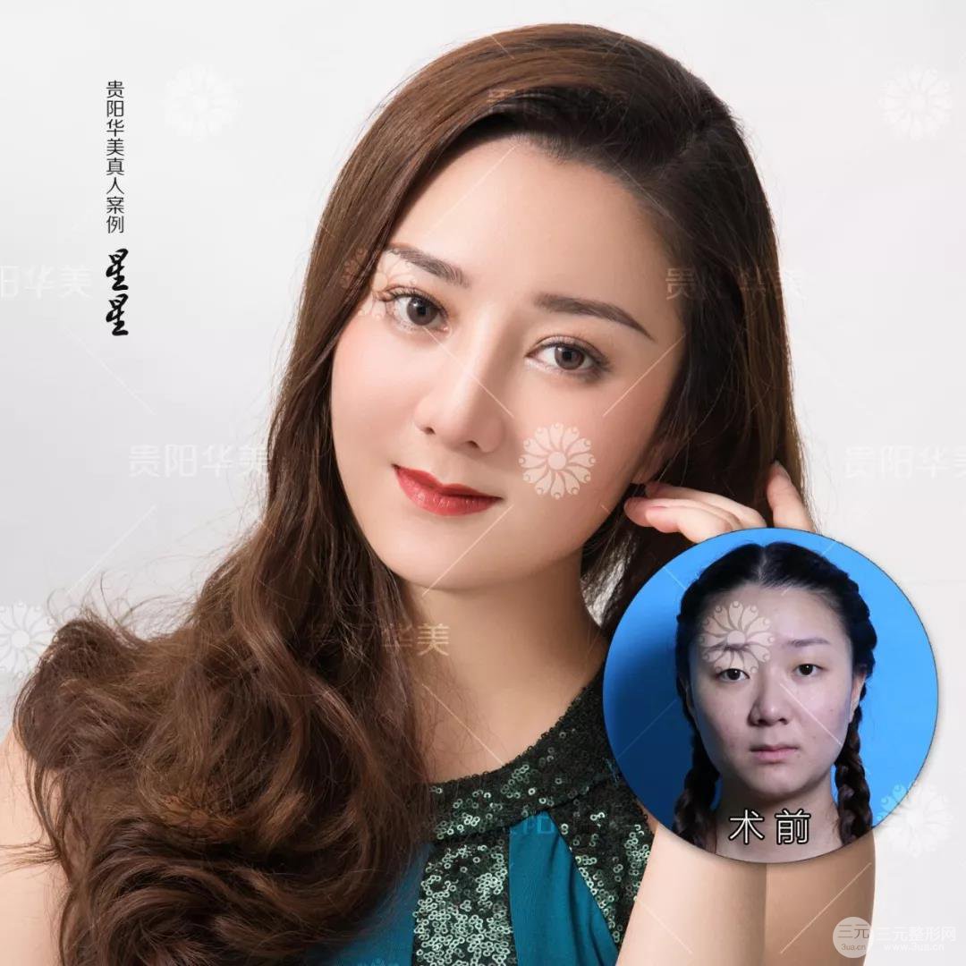 貴陽華美郭宗科全切雙眼皮+假體隆鼻案例前后對比圖 華美員工全臉整形實錄