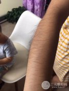 冰點華爾茲脫毛果過程緩解分享