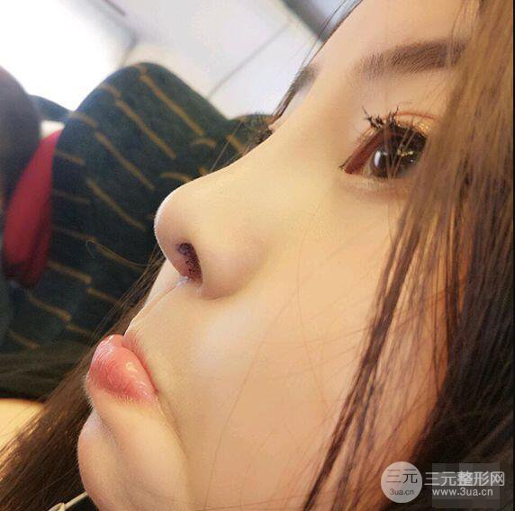 合肥壹加壹甘泉涌軟骨隆鼻前后對(duì)比圖|內(nèi)附真人案例恢復(fù)前過(guò)程