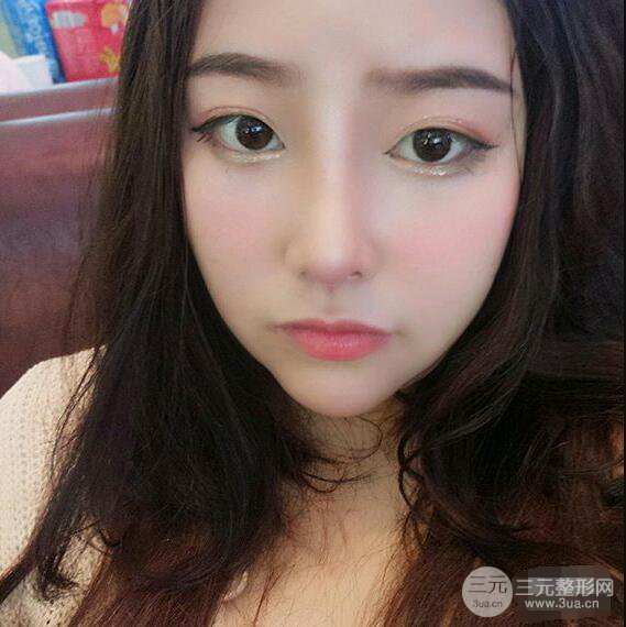 合肥壹加壹甘泉涌軟骨隆鼻前后對(duì)比圖|內(nèi)附真人案例恢復(fù)前過(guò)程