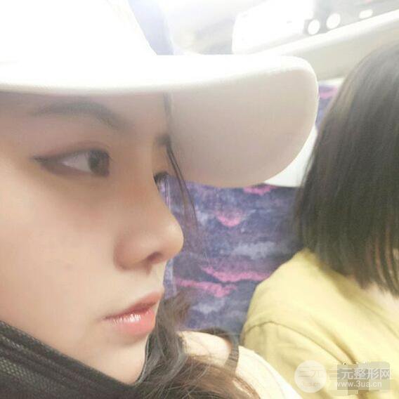 合肥壹加壹甘泉涌軟骨隆鼻前后對(duì)比圖|內(nèi)附真人案例恢復(fù)前過(guò)程