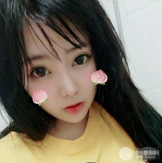 合肥壹加壹甘泉涌軟骨隆鼻前后對(duì)比圖|內(nèi)附真人案例恢復(fù)前過(guò)程