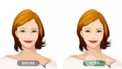 注射瘦臉生物除皺多少錢?