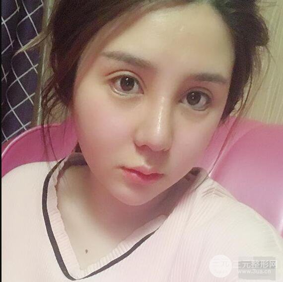 昆明吳氏嘉美李明硅膠隆鼻前后對比圖恢復心情小札