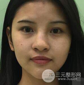 成都華西醫(yī)院整形美容科卿勇隆鼻整形前后對比圖恢復心情小札