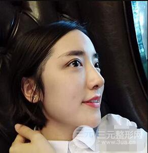 杭州格萊美張樹(shù)功假體隆鼻前后對(duì)比圖|內(nèi)附恢復(fù)心情變化哦