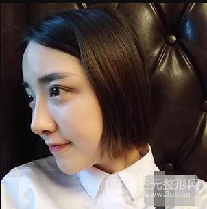 杭州格萊美張樹(shù)功假體隆鼻前后對(duì)比圖|內(nèi)附恢復(fù)心情變化哦