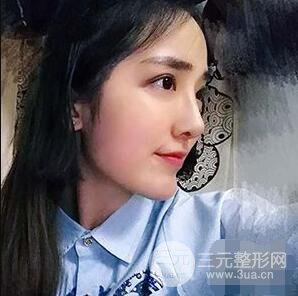 杭州格萊美張樹(shù)功假體隆鼻前后對(duì)比圖|內(nèi)附恢復(fù)心情變化哦