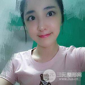 杭州格萊美張樹(shù)功假體隆鼻前后對(duì)比圖|內(nèi)附恢復(fù)心情變化哦