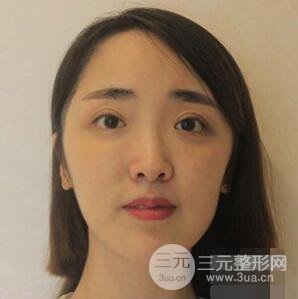 杭州格萊美張樹(shù)功假體隆鼻前后對(duì)比圖|內(nèi)附恢復(fù)心情變化哦