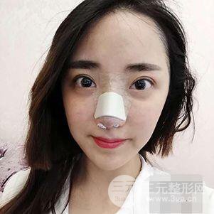 杭州格萊美張樹(shù)功假體隆鼻前后對(duì)比圖|內(nèi)附恢復(fù)心情變化哦