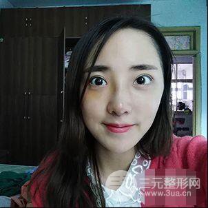 杭州格萊美張樹(shù)功假體隆鼻前后對(duì)比圖|內(nèi)附恢復(fù)心情變化哦