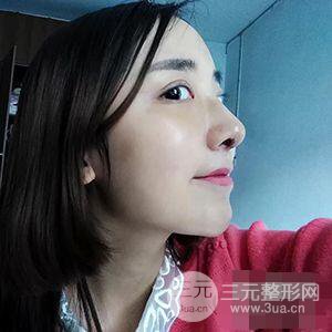 杭州格萊美張樹(shù)功假體隆鼻前后對(duì)比圖|內(nèi)附恢復(fù)心情變化哦