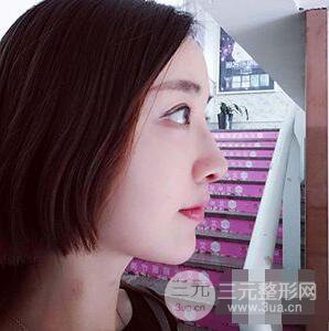 杭州格萊美張樹(shù)功假體隆鼻前后對(duì)比圖|內(nèi)附恢復(fù)心情變化哦