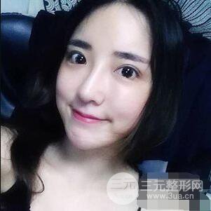 杭州格萊美張樹(shù)功假體隆鼻前后對(duì)比圖|內(nèi)附恢復(fù)心情變化哦