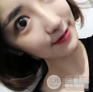 杭州格萊美張樹(shù)功假體隆鼻前后對(duì)比圖|內(nèi)附恢復(fù)心情變化哦