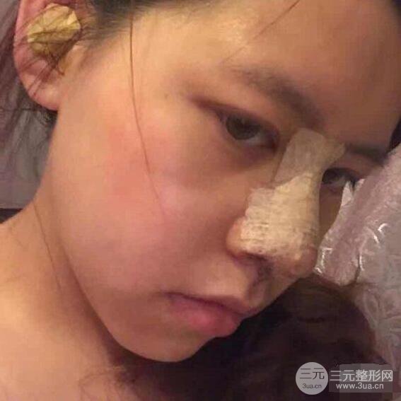 重慶華美何春濤硅膠隆鼻前后對(duì)比圖 內(nèi)附恢復(fù)心情小札