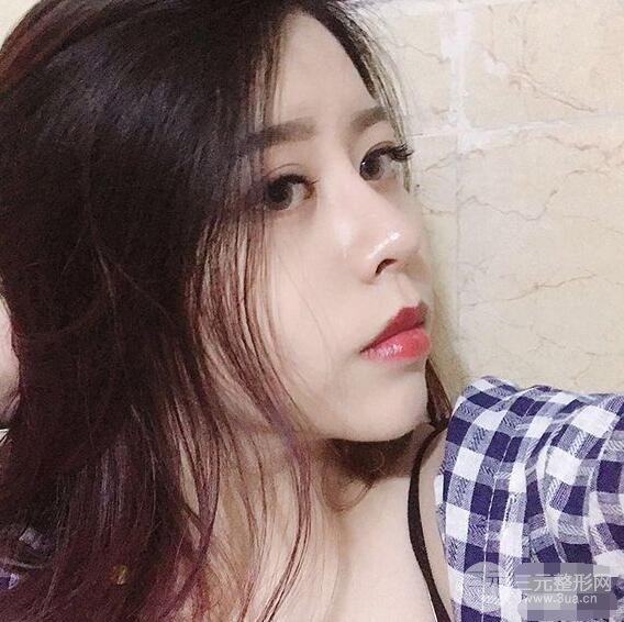 重慶華美何春濤硅膠隆鼻前后對(duì)比圖 內(nèi)附恢復(fù)心情小札