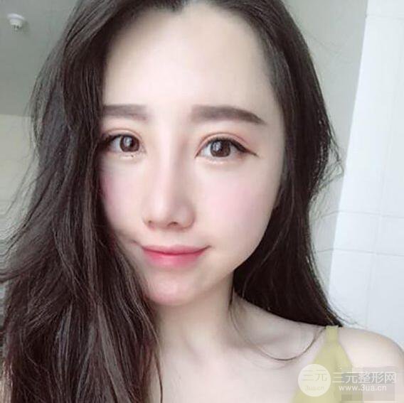 北京聯(lián)合麗格吳焱秋耳軟骨隆鼻前后對比圖|塌鼻子的救星