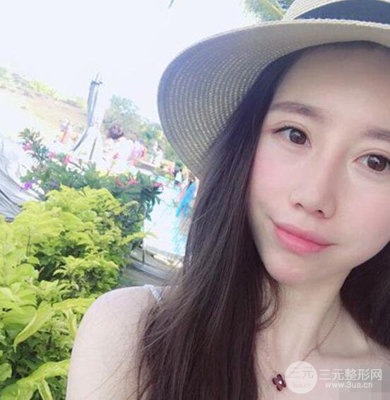 北京聯(lián)合麗格吳焱秋耳軟骨隆鼻前后對比圖|塌鼻子的救星