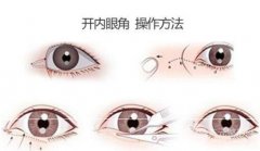 成都韓式微創(chuàng)開眼角多少錢?