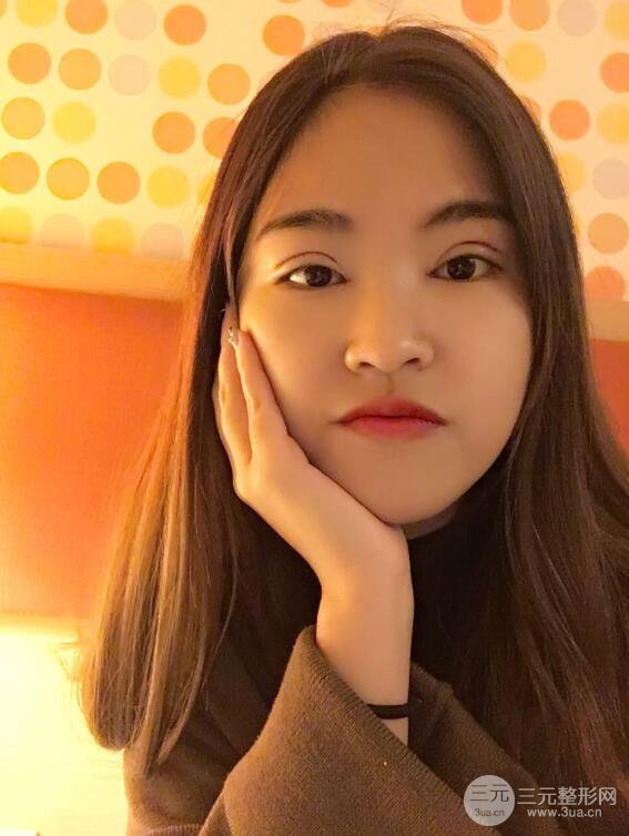 沈陽百嘉麗葉微微切開雙眼皮前后對(duì)比圖恢復(fù)心情小札