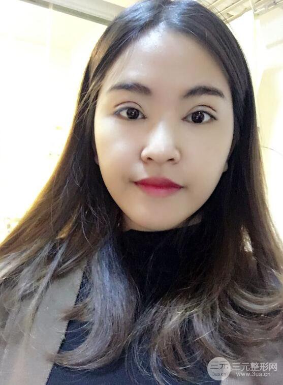 沈陽百嘉麗葉微微切開雙眼皮前后對(duì)比圖恢復(fù)心情小札