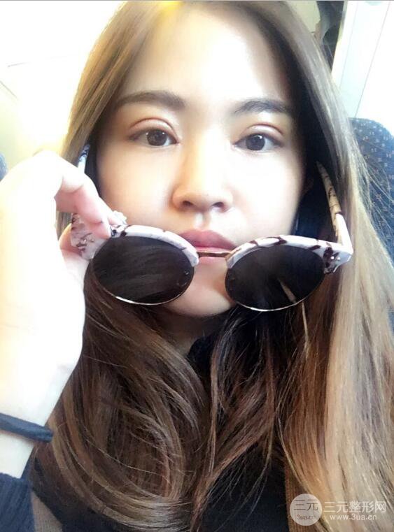 沈陽百嘉麗葉微微切開雙眼皮前后對(duì)比圖恢復(fù)心情小札