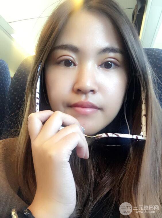 沈陽百嘉麗葉微微切開雙眼皮前后對(duì)比圖恢復(fù)心情小札