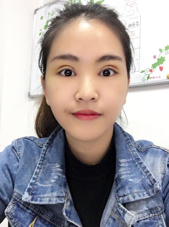 沈陽百嘉麗葉微微切開雙眼皮前后對(duì)比圖恢復(fù)心情小札