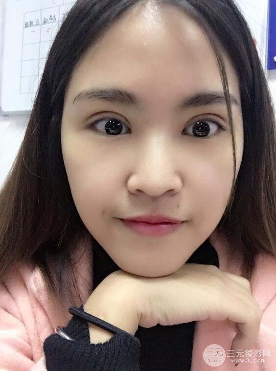 沈陽百嘉麗葉微微切開雙眼皮前后對(duì)比圖恢復(fù)心情小札