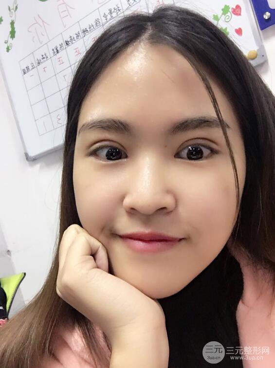 沈陽百嘉麗葉微微切開雙眼皮前后對(duì)比圖恢復(fù)心情小札