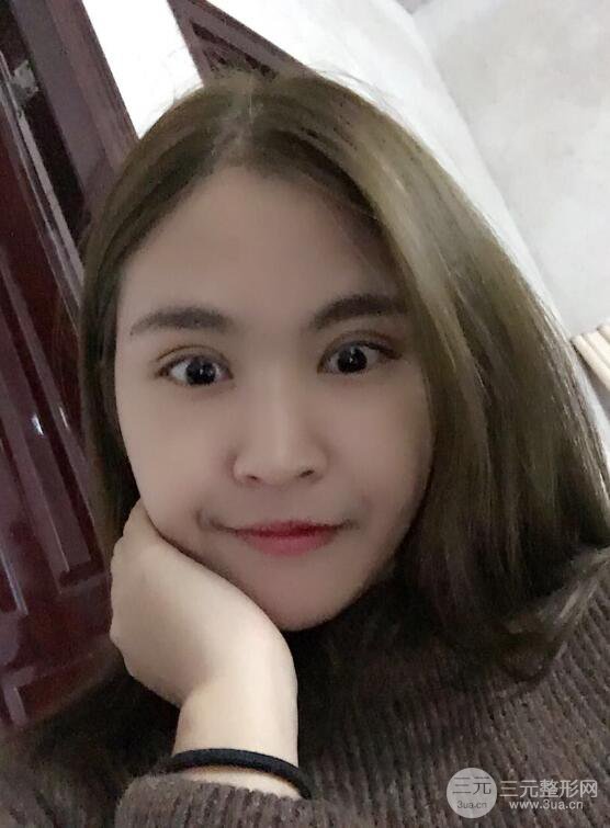 沈陽百嘉麗葉微微切開雙眼皮前后對(duì)比圖恢復(fù)心情小札