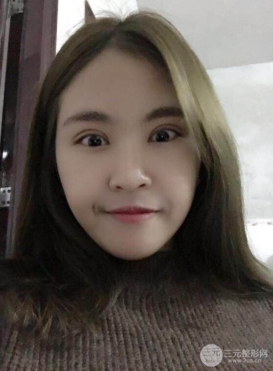 沈陽百嘉麗葉微微切開雙眼皮前后對(duì)比圖恢復(fù)心情小札