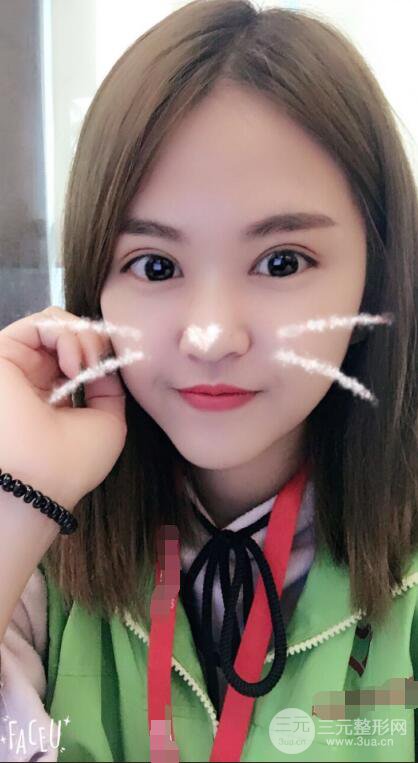 沈陽百嘉麗葉微微切開雙眼皮前后對(duì)比圖恢復(fù)心情小札