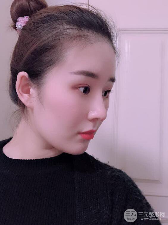 上海華美李庭勛膨體隆鼻前后對比圖一個月恢復(fù)心情日記