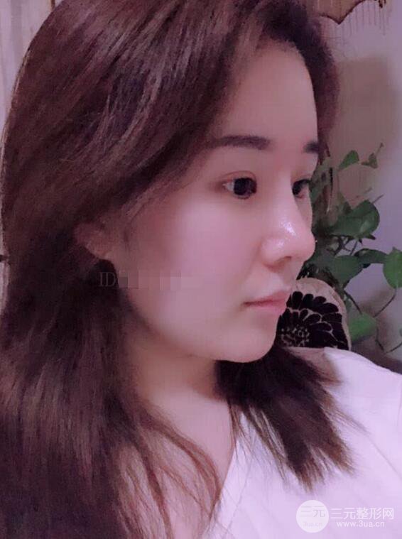 上海華美李庭勛膨體隆鼻前后對比圖一個月恢復(fù)心情日記