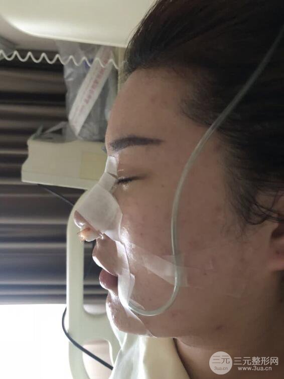 上海華美李庭勛膨體隆鼻前后對比圖一個月恢復(fù)心情日記