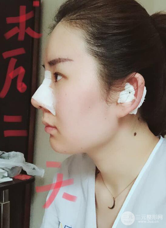 上海華美李庭勛膨體隆鼻前后對比圖一個月恢復(fù)心情日記