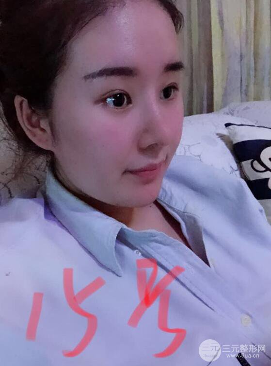 上海華美李庭勛膨體隆鼻前后對比圖一個月恢復(fù)心情日記