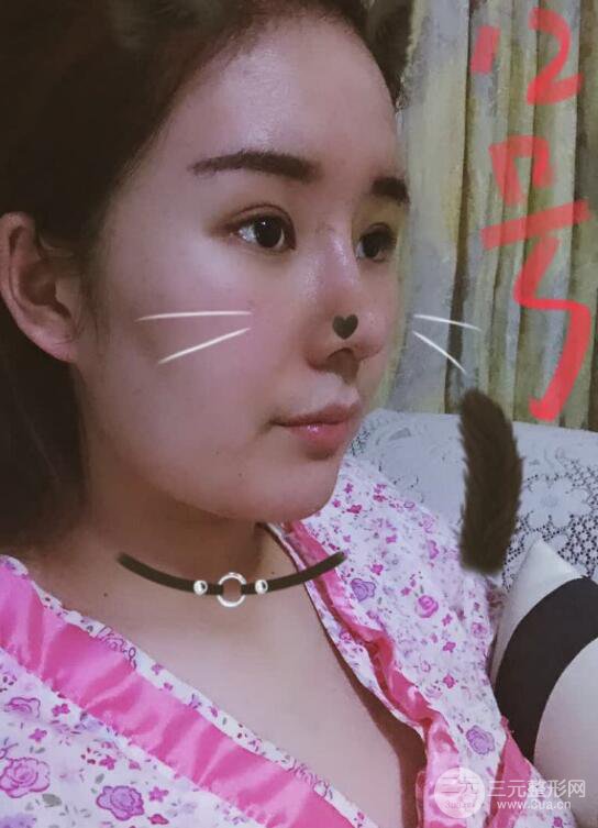上海華美李庭勛膨體隆鼻前后對比圖一個月恢復(fù)心情日記