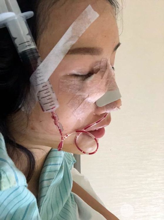 昆明華美美萊楊繼紅肋軟骨隆鼻前后對(duì)比圖恢復(fù)手札