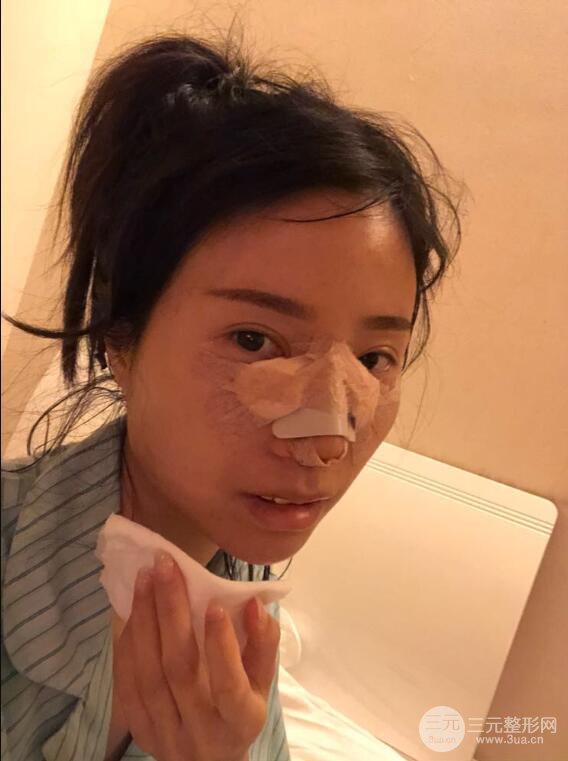 昆明華美美萊楊繼紅肋軟骨隆鼻前后對(duì)比圖恢復(fù)手札