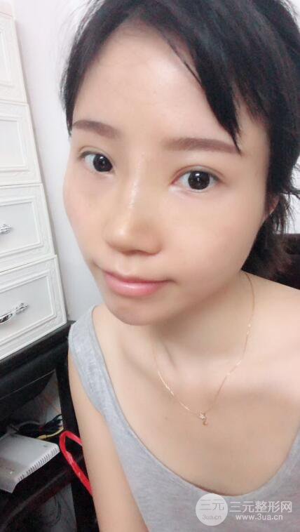 昆明華美美萊楊繼紅肋軟骨隆鼻前后對(duì)比圖恢復(fù)手札